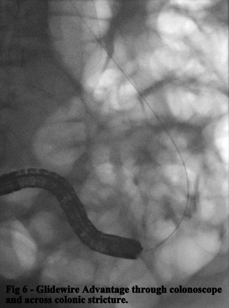 Fig 6. Glidewire Advantage through colonoscope and across colonic stricture